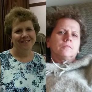 A pic of how I usually look to others, and how I look at home. It was hard to post the 2nd pic, but it's important to make people see the "visible" part of invisible illness. #myinvisiblefight #iiwk #invisibleillness